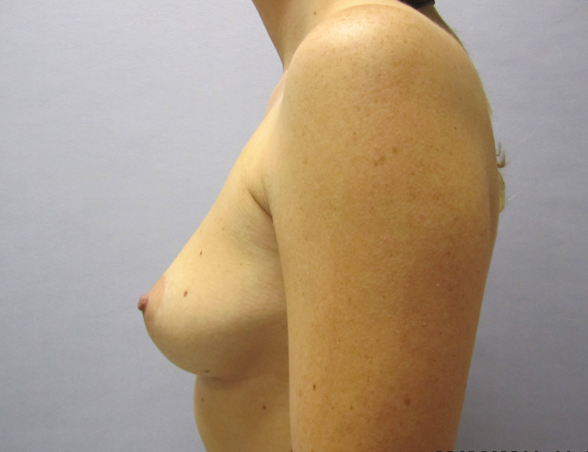 before breast augmentation side view female patient case 2696
