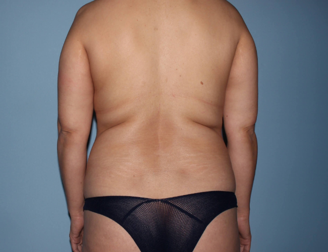 image before breast augmentation with buttock fat grafting - back view case 3270