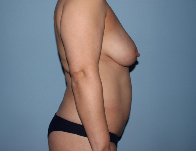 image before breast augmentation with buttock fat grafting - right angle case 3270