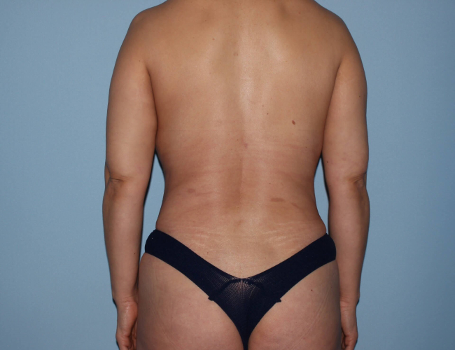 image after breast augmentation with buttock fat grafting - back view case 3270