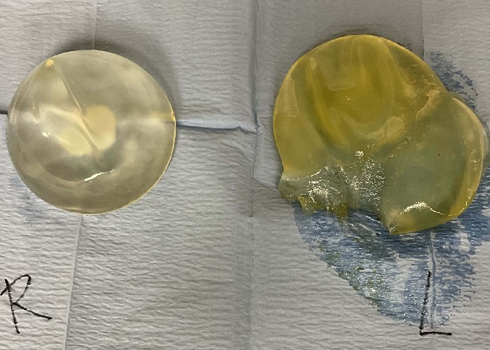 removed breast implants on patient case 4417