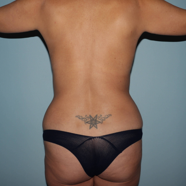 before liposuction - vaser assisted liposuction back arms sideward view case 4406