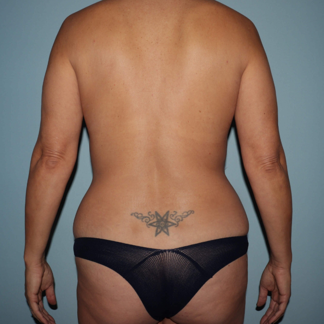 before liposuction - vaser assisted liposuction back view case 4406