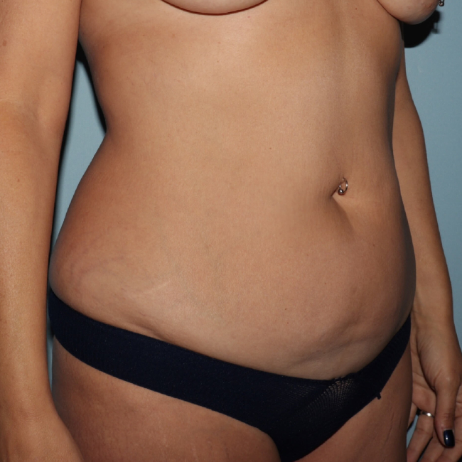 before liposuction - vaser assisted liposuction 45 degrees right angle case 4406