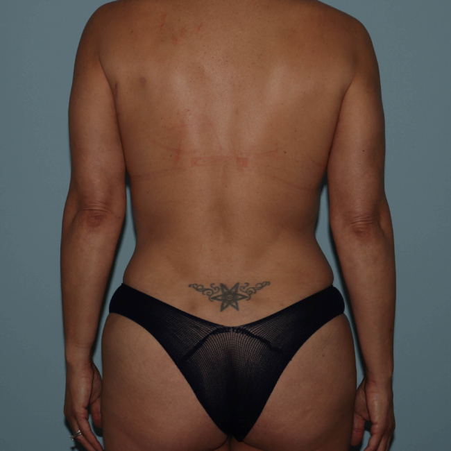 after liposuction - vaser assisted liposuction back view case 4406