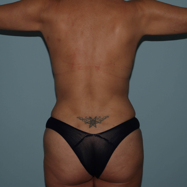 after liposuction - vaser assisted liposuction back view arms sideward case 4406