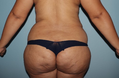Before Image Tummy Tuck With Vaser Liposuction Back Side View Case 3488
