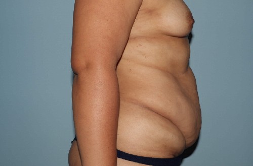 Before Image Tummy Tuck With Vaser Liposuction Right Side View Case 3488