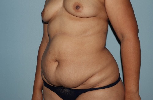 Before Image Tummy Tuck With Vaser Liposuction Left Side 45 Degree View Case 3488