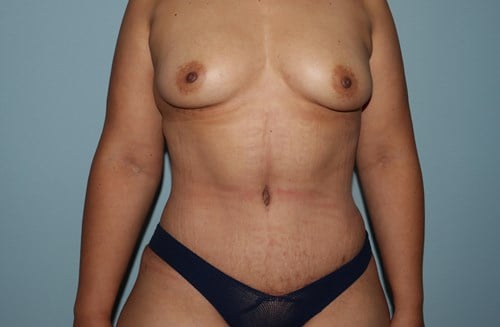 After Image Tummy Tuck With Vaser Liposuction Front Side View Case 3488