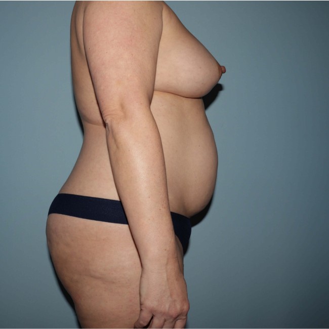 Before Image of Tummy Tuck with Liposuction Right Side Case 3563