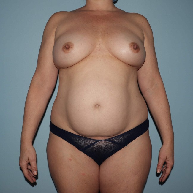 Before Image of Tummy Tuck with Liposuction Front Side Case 3563