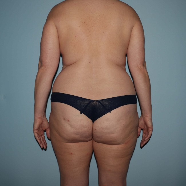 Before Image of Tummy Tuck with Liposuction Back Side Case 3563