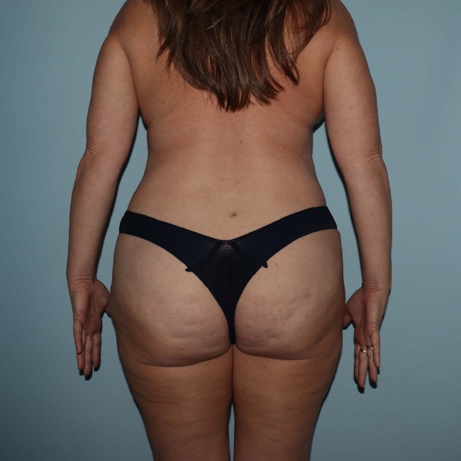After Image of Tummy Tuck with Liposuction Left Side View Case 3563