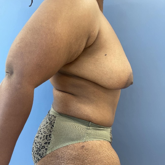after tummy tuck after pregnancy - right angle case 3590
