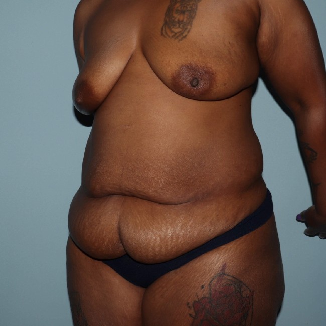 before tummy tuck after pregnancy - 45 degrees left angle case 3590