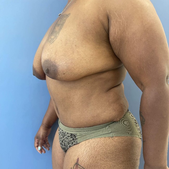 after tummy tuck after pregnancy - left angle case 3590