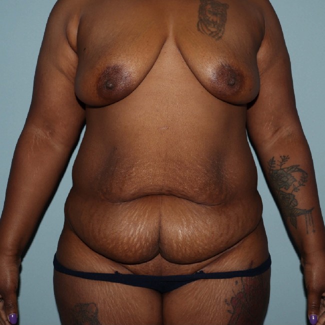 before tummy tuck after pregnancy - front view case 3590