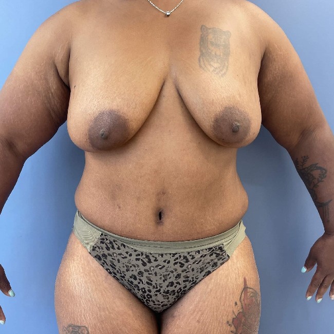 after tummy tuck after pregnancy - front view case 3590