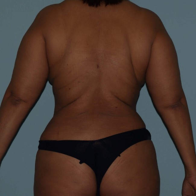 After Image of Tummy Tuck with Liposuction Female Back Side View 3598