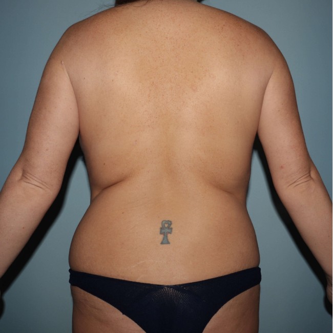 Before Image of Tummy Tuck Patient back Side View Case 3609