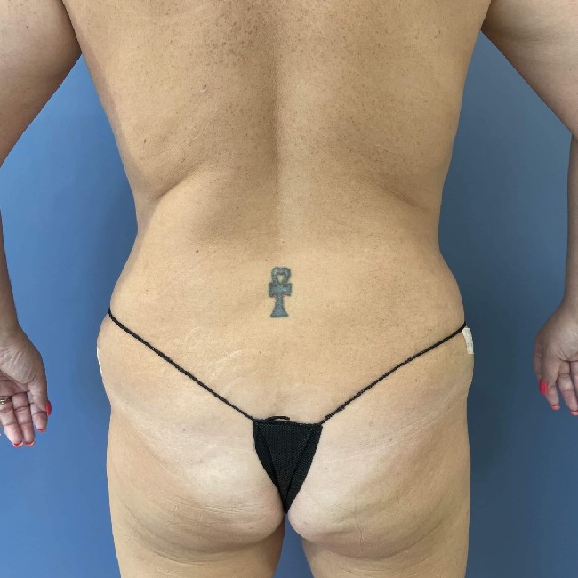 After Image of Tummy Tuck Patient Back Side View Case 3609