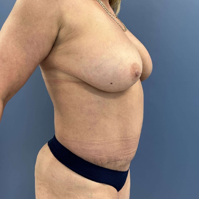 After Image of Tummy Tuck and Hernia Repair Right side 45 degree view Case 3618