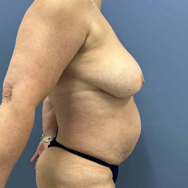 Before Image of Tummy Tuck and Hernia Repair Right side view Case 3618