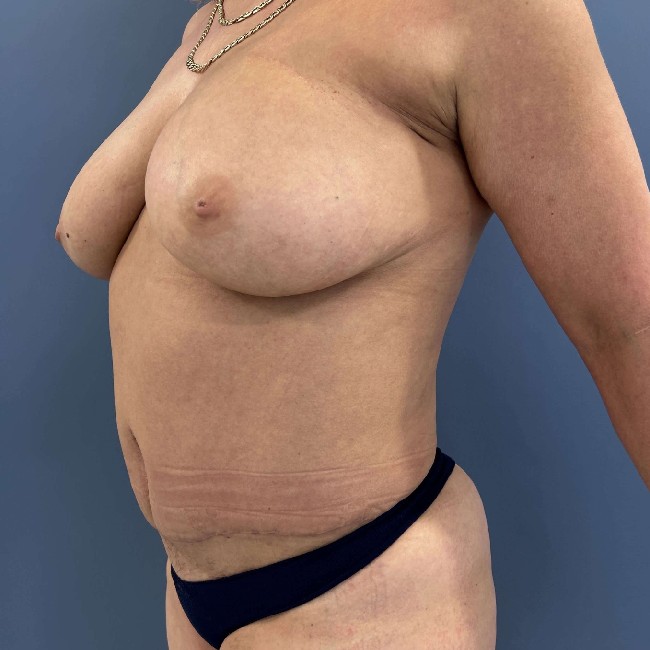 After Image of Tummy Tuck and Hernia Repair Left side 45 degree view Case 3618