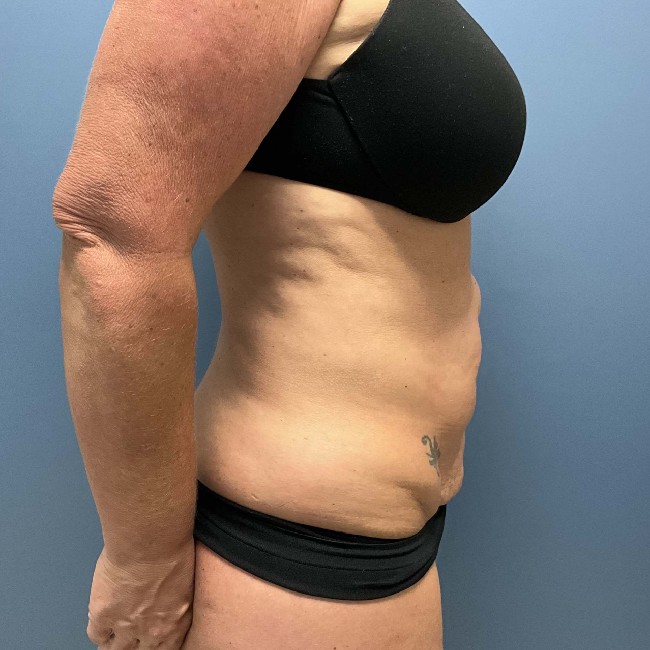 Before Image of Tummy Tuck with Hernia Repair Right Side Case- 3653