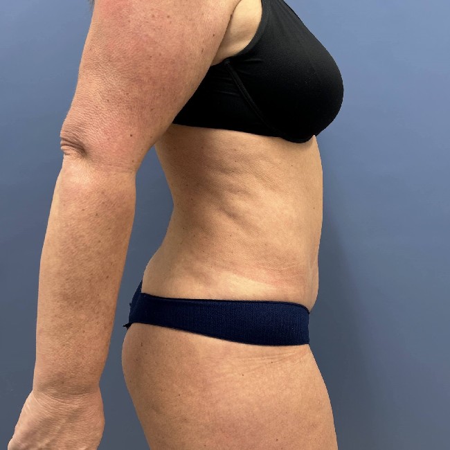 After Image of Tummy Tuck with Hernia Repair Right Side Case- 3653