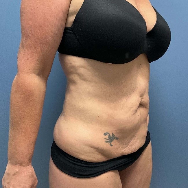 Before Image of Tummy Tuck with Hernia Repair Right Side 45 degree Case- 3653