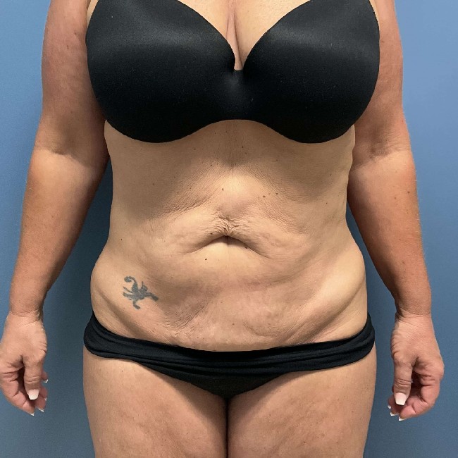 Before Image of Tummy Tuck with Hernia Repair Front Side View Case- 3653