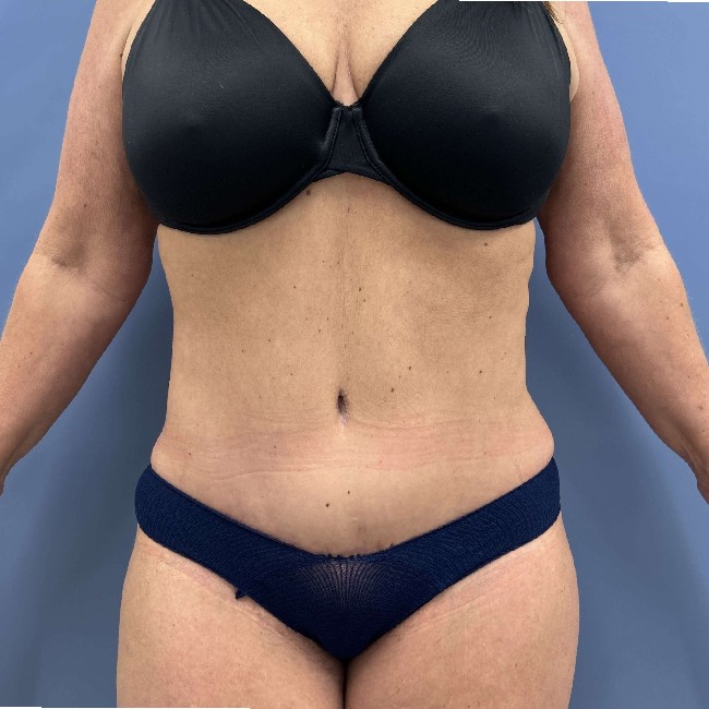 After Image of Tummy Tuck with Hernia Repair Front Side View Case- 3653