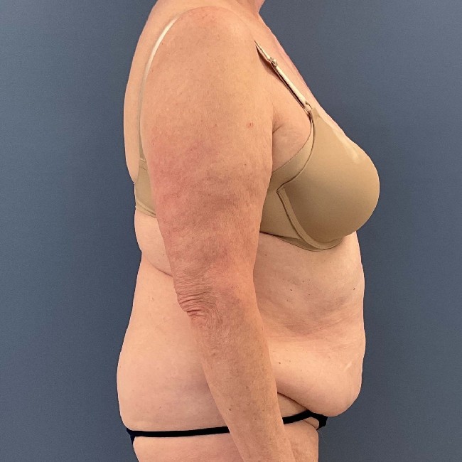 before tummy tuck - over 50 years old patient right angle case 3729