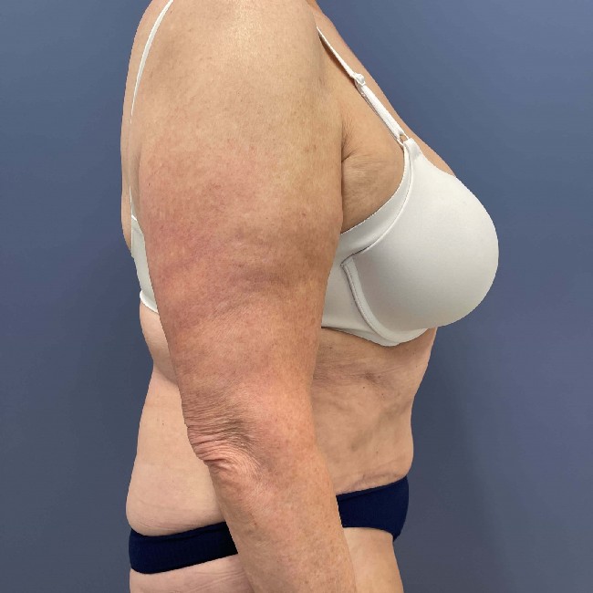 after tummy tuck - over 50 years old patient right angle case 3729