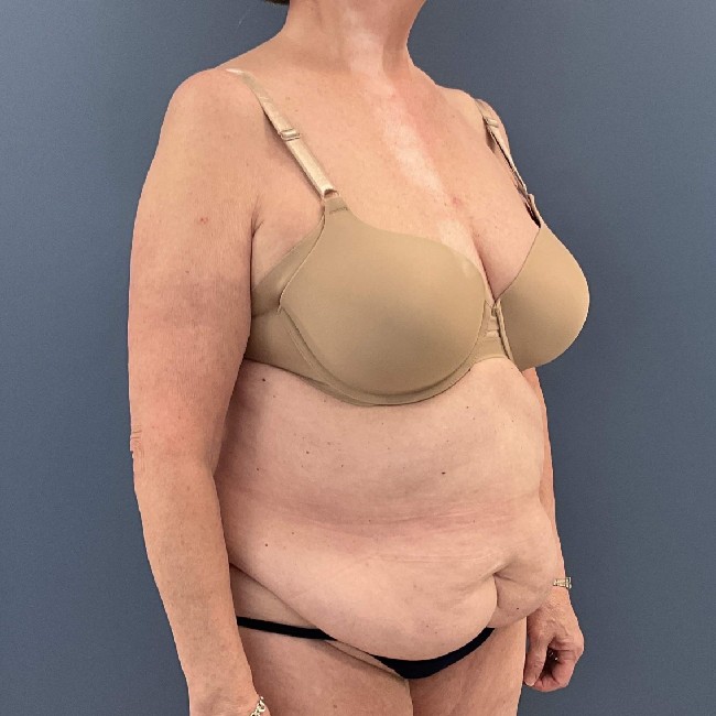 before tummy tuck - over 50 years old patient 45 degrees right angle case 3729