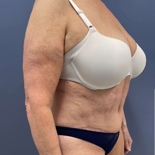 after tummy tuck - over 50 years old patient 45 degrees right angle case 3729