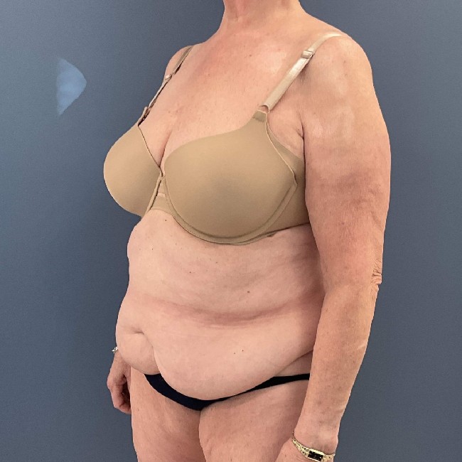 before tummy tuck - over 50 years old patient 45 degrees left angle case 3729