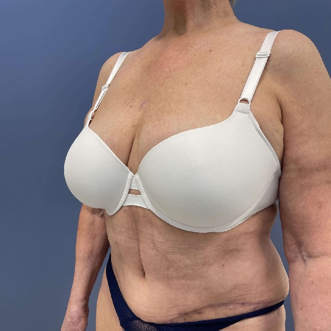 after tummy tuck - over 50 years old patient 45 degrees left angle case 3729