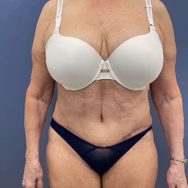after tummy tuck - over 50 years old patient front view case 3729