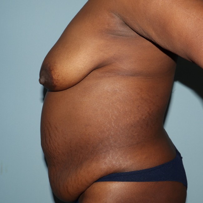 before overweight tummy tuck - left angle case 3740