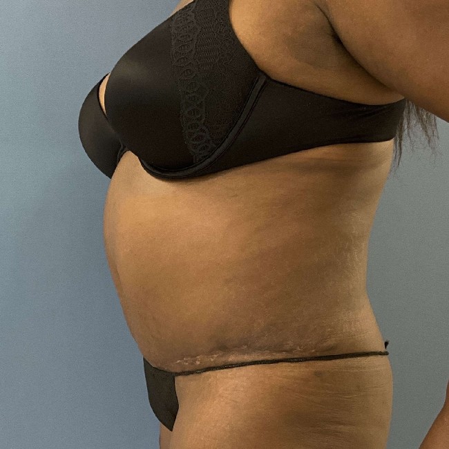 after overweight tummy tuck - left angle case 3740