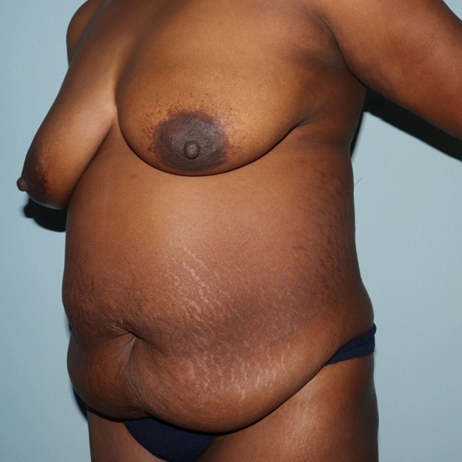 before overweight tummy tuck - 45 degrees left angle case 3740