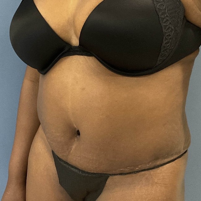 after overweight tummy tuck - 45 degrees left angle case 3740