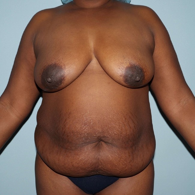 before overweight tummy tuck - front view case 3740
