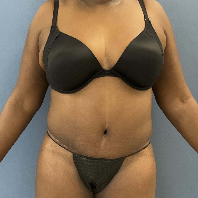 after overweight tummy tuck - front view case 3740