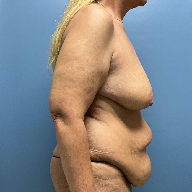before mommy makeover after weight loss - tummy tuck right angle case 3747