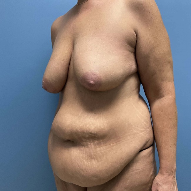 before mommy makeover after weight loss - tummy tuck 45 degrees left angle case 3747