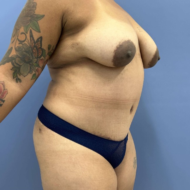 after tummy tuck 45 degrees right angle case 3754